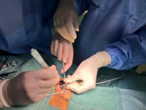 Hospital de Tomar realiza cirurgia pioneira no combate à dor crónica