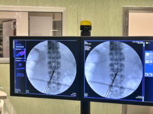 Hospital de Tomar realiza cirurgia pioneira no combate à dor crónica