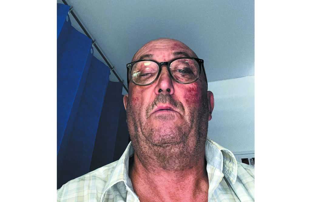 Homem de Ferreira do Zêzere voltou hoje a ser agredido